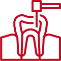 dentique-Leczenie endodontyczne (kanałowe).png