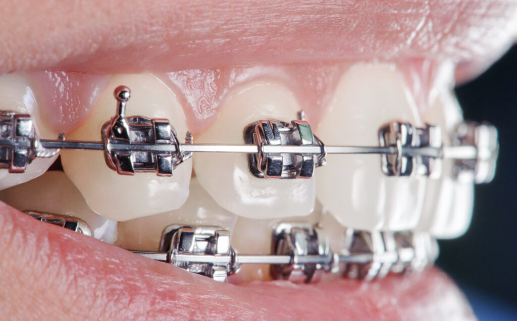 DentiQue Stomatologia Wrocław close up dental braces on teeth orthodontic treat 2025 01 16 23 27 41 utc