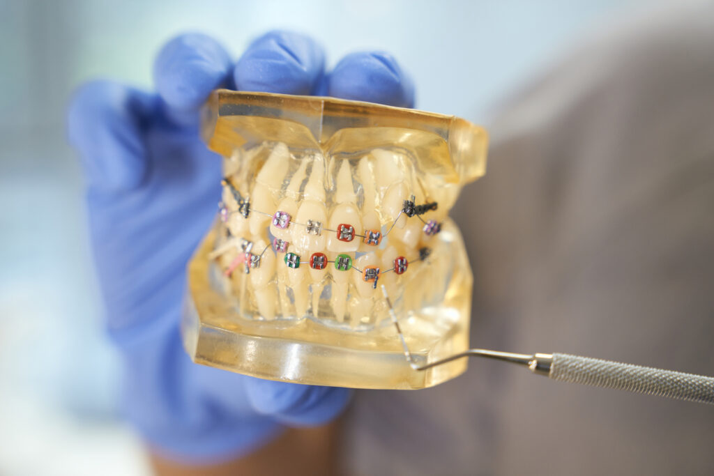 DentiQue Stomatologia Wrocław dental specialist showing a set of braces on teeth 2023 11 27 05 16 36 utc