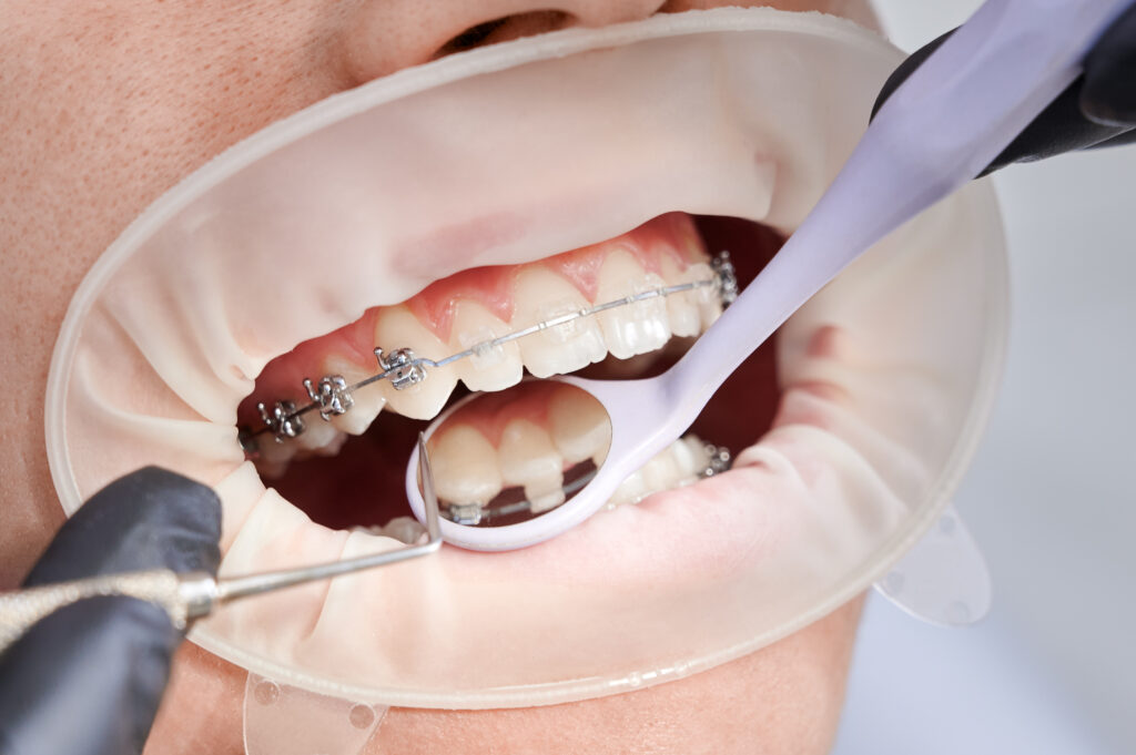 DentiQue Stomatologia Wrocław dentist attaching metal braces to patient teeth 2025 01 17 00 13 01 utc