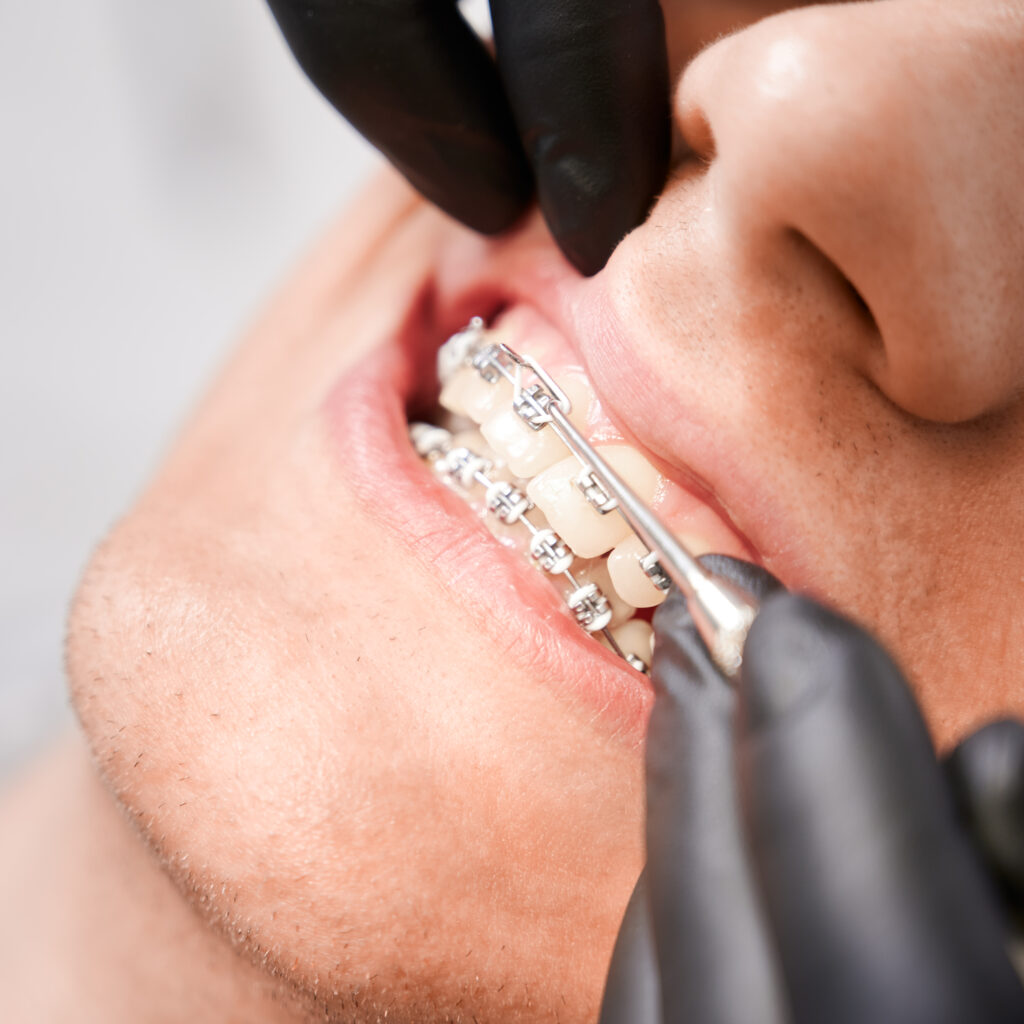 DentiQue Stomatologia Wrocław dentist placing rubber bands on male patient brace 2025 01 16 23 43 11 utc