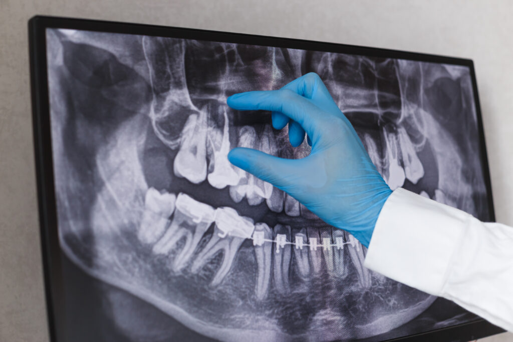 DentiQue Stomatologia Wrocław doctor points to filled root canal in dental x ray 2025 02 14 15 27 44 utc