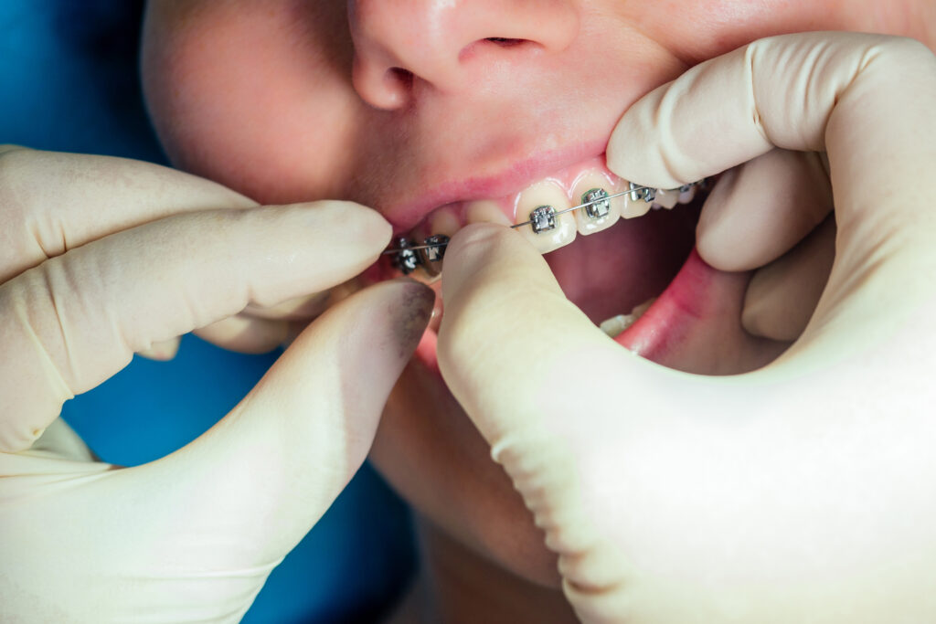 DentiQue Stomatologia Wrocław female dental open mouth with fixator gel braces a 2024 10 31 04 19 52 utc